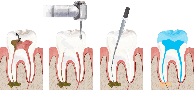 Root canal procedure