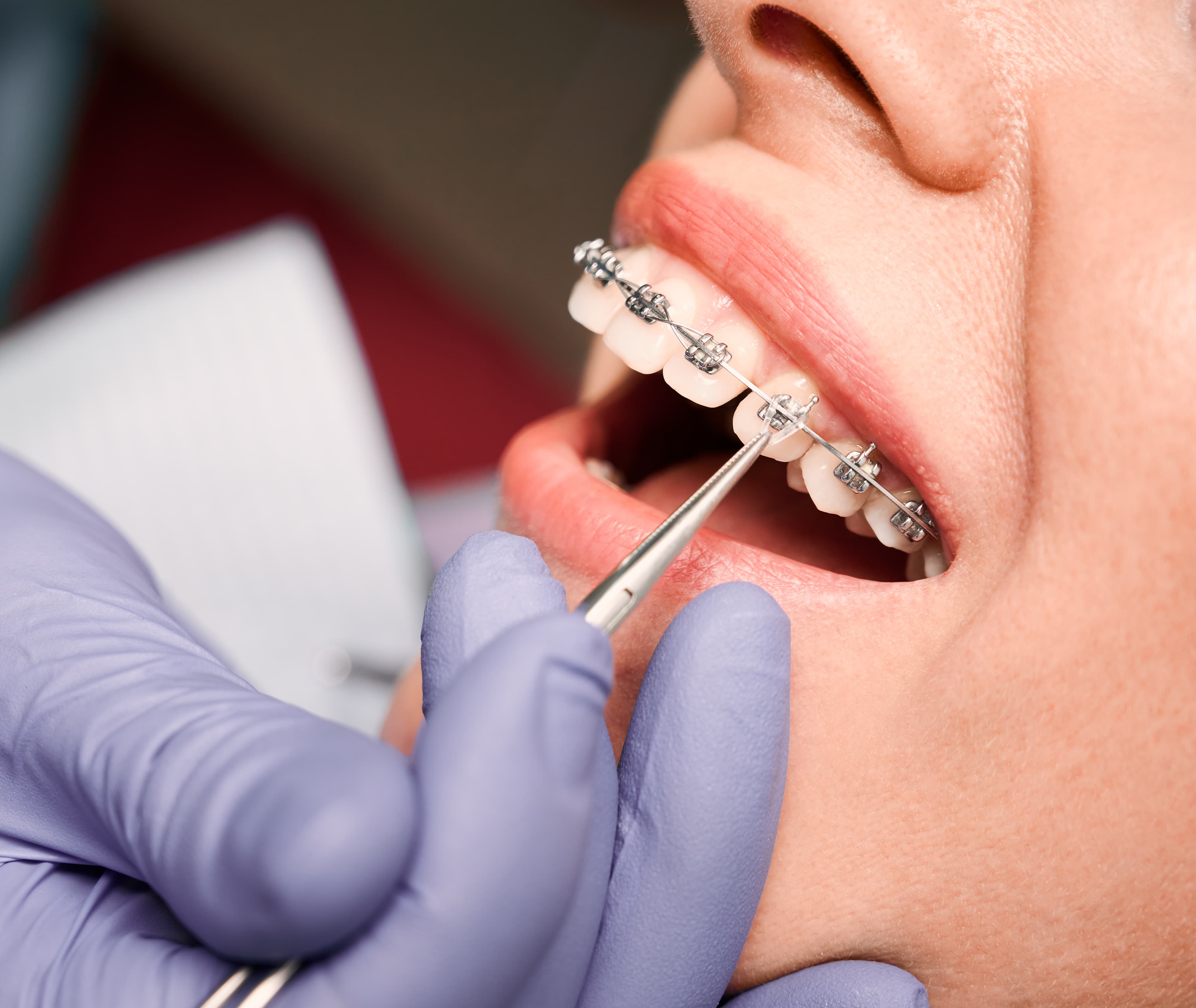 Metal Braces