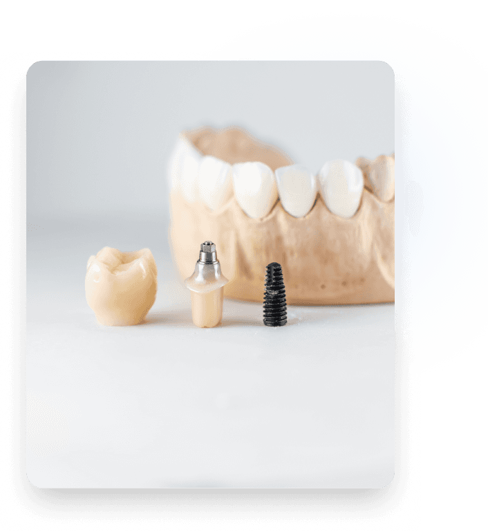 Dental implants showcase