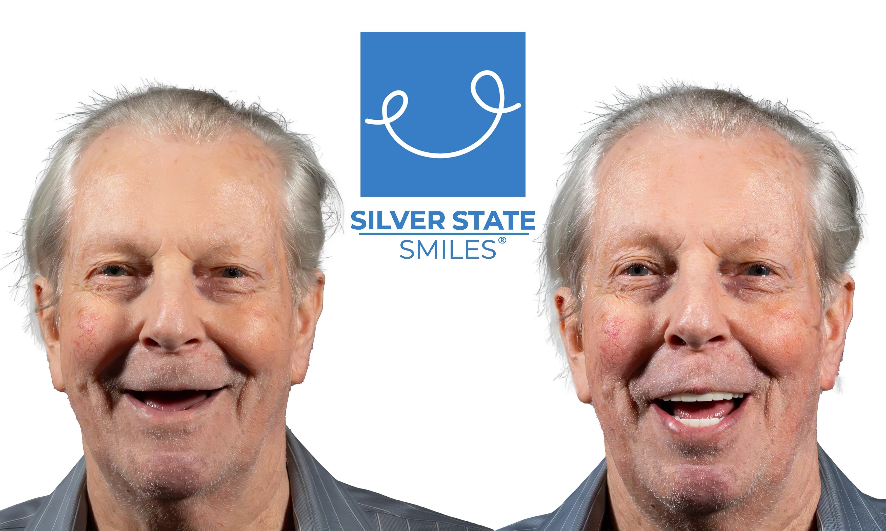 Patient smile transformation - Before and after dental treatment