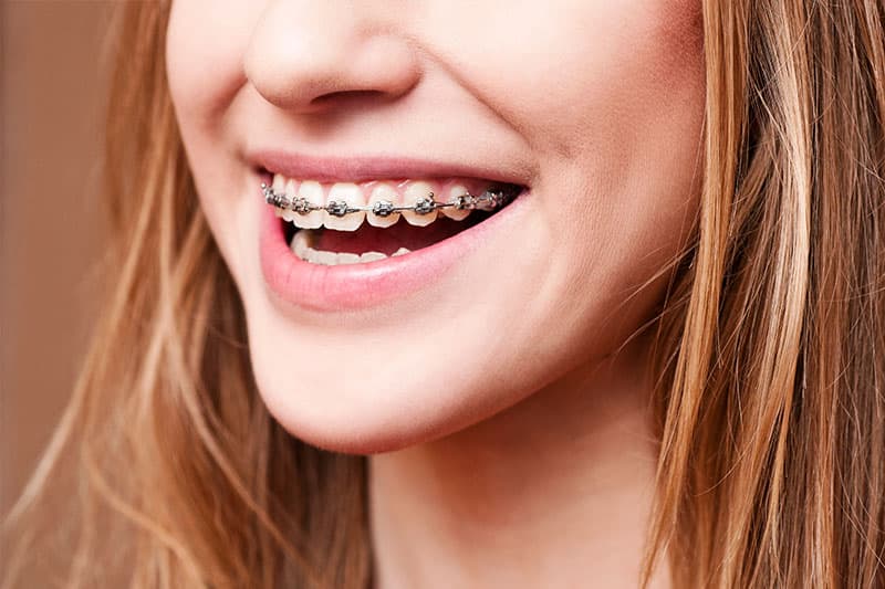 Orthodontic treatment