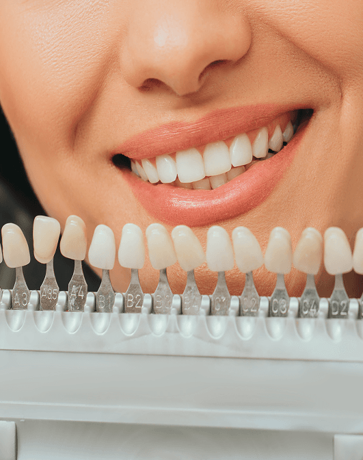 Beautiful smile with veneers